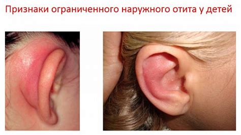 Почему чешутся уши внутри у человека — зуд в ушах, причина и лечение ...