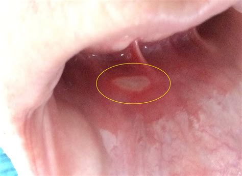 Causes For Frequent Mouth Ulcers - Infoupdate.org