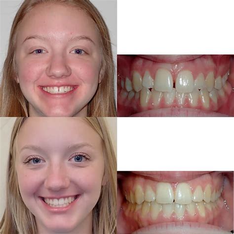 Before And After Braces Adults