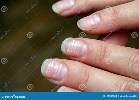 Iron Deficiency Anemia Nails