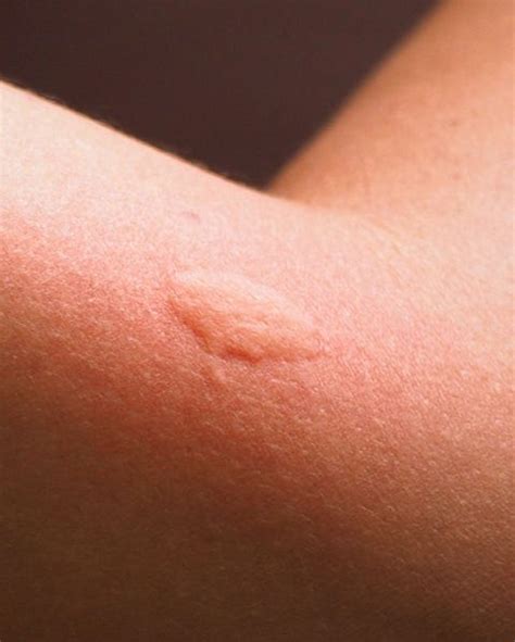 11 Common Bug Bite Pictures - How to ID Insect Bites and Stings