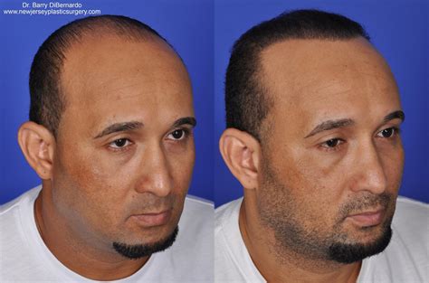 hair transplant