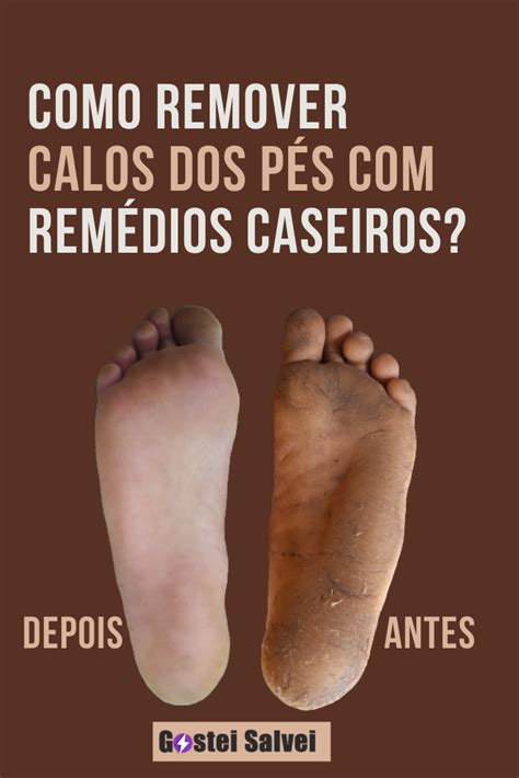 Como Acabar Com Calos Nos Pés - Como remover calos dos pés com truques caseiros? – GosteiSalvei
