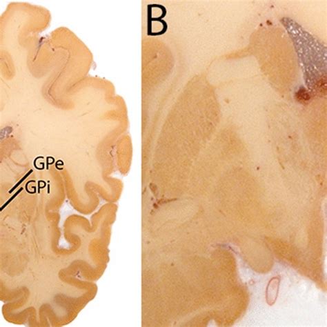 A Globus pallidus internal and external segment (GPi and GPe) in a ...