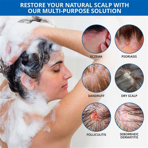 Dry Scalp Eczema