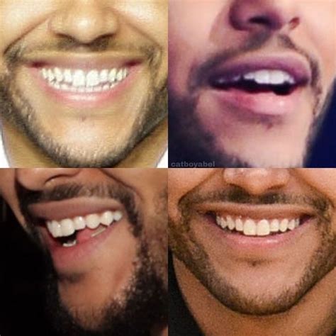 weeknd veneers  closer    dazzling smile  weeknd