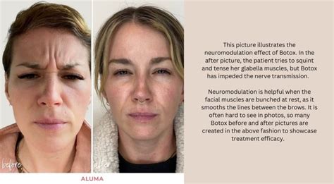 botox works  long  lasts   safe