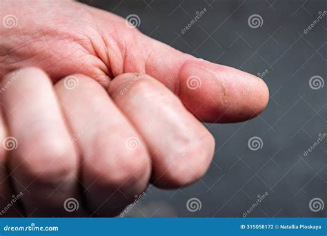 Finger with Scar after Being Cut with Knife. Stock Photo - Image of ...