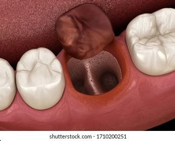 Infected Socket Teeth: Over 9 Royalty-Free Licensable Stock ...