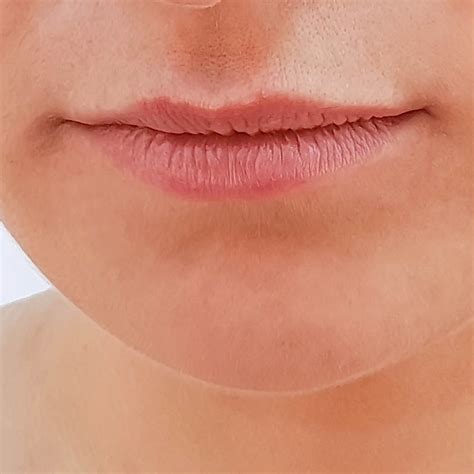 Loss of Facial Volume Treatment in Singapore: Cheeks & Under Eyes