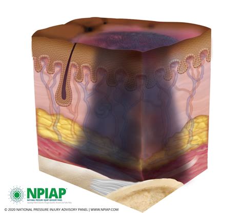 Pressure Injury Stages National Pressure Ulcer Advisory, 58% OFF