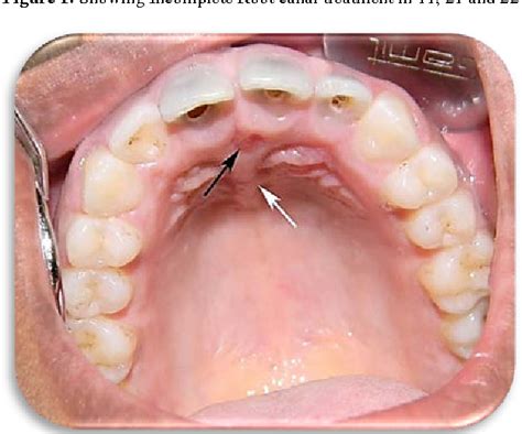 Nasopalatine Duct cyst: A Clinical Deception | Semantic Scholar