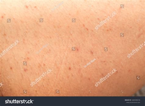 Close Picture Folliculitis On Human Skin Stock Photo 1683598318 ...