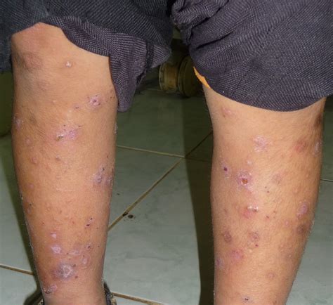 Scabies Burrows After Treatment