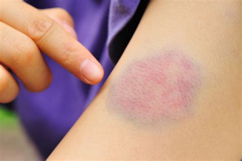 How to get rid of bruises: 7 effective home remedies