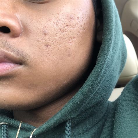 Dermatologists explain the science behind those stubborn big blackheads 28