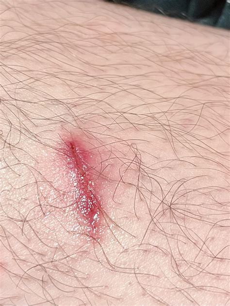Infected? : r/woundcare