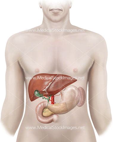 Distal Pancreatectomy Procedure – Medical Stock Images Company