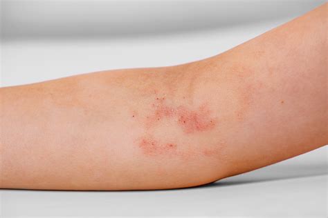 New atopic dermatitis treatments in development