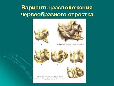 ОСТРЫЙ АППЕНДИЦИТ Варианты расположения червеобразного отростка