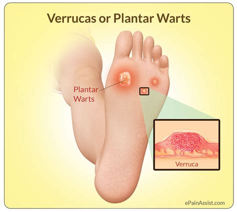 NYC Podiatry Center of Excellence | Plantar Warts