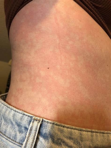 White spots after drinking? : r/medical