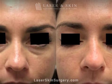 pixel laser eye treatment  dark circles