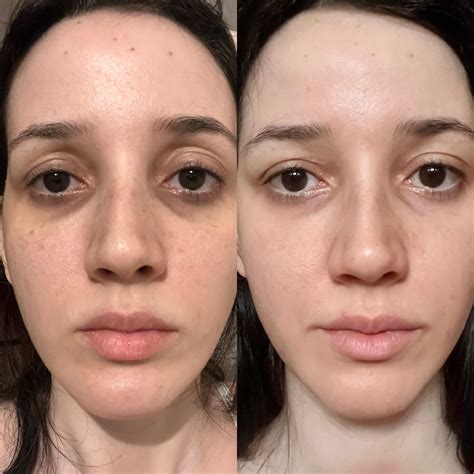 3 months tretinoin 0,05% Results! : r/tretinoin