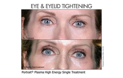 NEOGEN™ PLASMA MELASMA TREATMENT - Cambridge Therapeutics