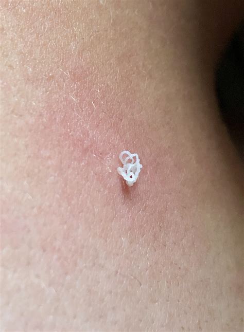 The end result from squeezing my bf’s neck. : r/popping