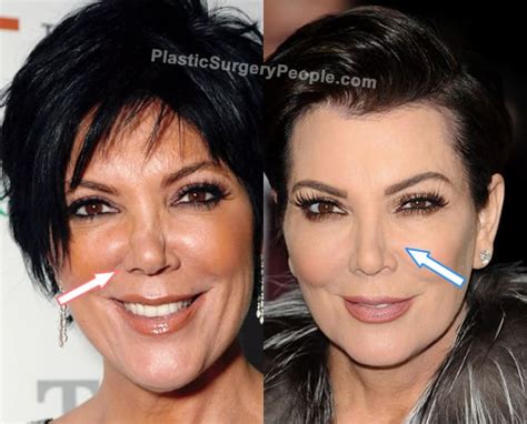 Kris Jenner: BEFORE and AFTER 2022