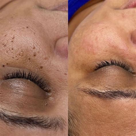 Adifyline Antes E Depois - Fármacos Farmácia de Manipulação - Adifyline™: Hexapeptídeo que ...