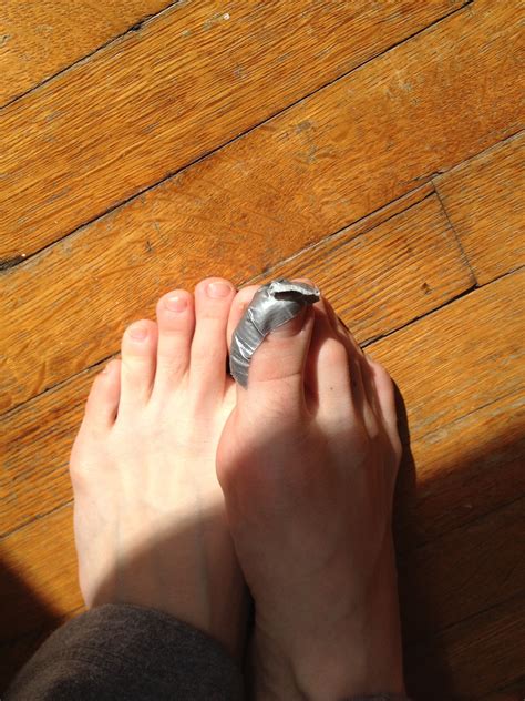 Get rid of plantar warts with duct tape