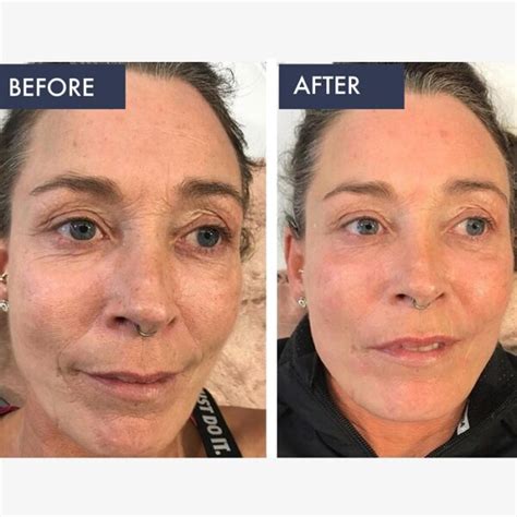 Retinol Before and After: Transform Your Skin with These Results - Must Read This Before Buying