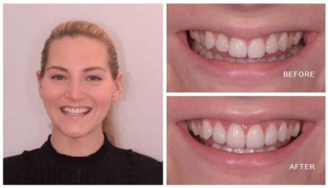 veneers london  star dental veneers  london marylebone smile clinic