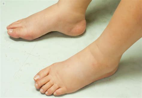 Edema: qué es, síntomas y tratamiento | Top Doctors