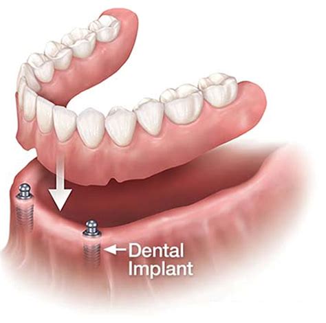 Scarsdale Advanced Dental | Dental Implant Overdenture In Scarsdale