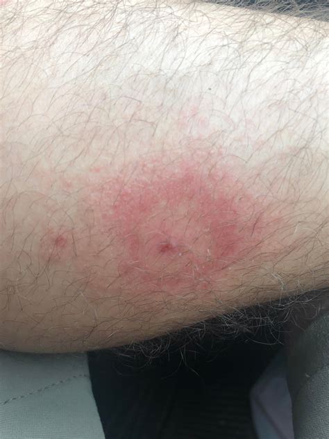 Very itchy calves. My legs have been itching very badly for about a