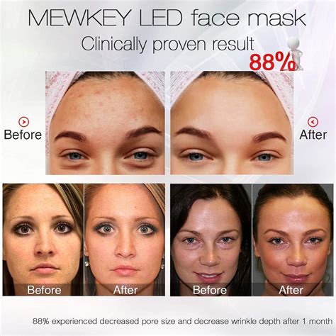 Project E Beauty LED Face Mask Before And After (30 Days), 40% OFF