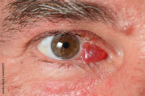 Healthcare, Closeup of human eye with hematoma Stock Photo | Adobe Stock