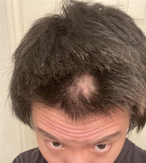 Dermatologists explain why the biggest spot popped so dramatically 27