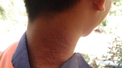 Xing Fu: ALOE VERA TO TREAT SKIN DISEASES