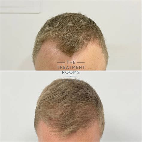 Mature vs. Receding Hairline | Treatment Rooms London