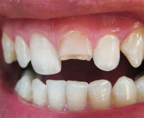 Fix Broken Tooth In Hervey Bay | Chipped & Cracked Tooth Repair