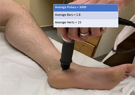 Nonsurgical Approach in Management of Tibialis Posterior Tendinopathy
