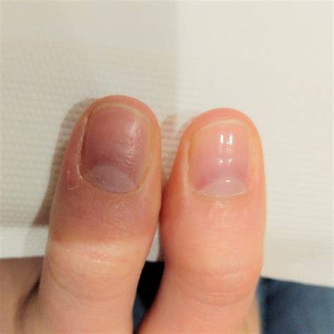 Where did the cuticle go? And why the bumpy nail? : r/Nails