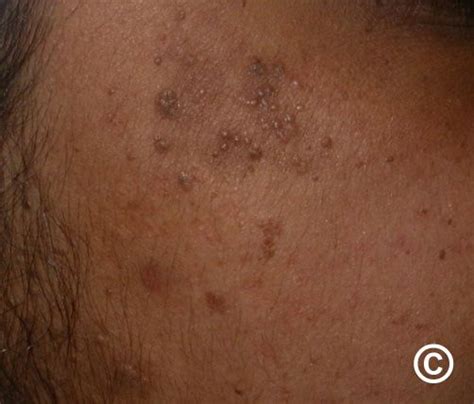 Genital Warts: Treatment, Causes, And Symptoms, 51% OFF
