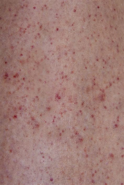 Bacterial Meningitis Rash