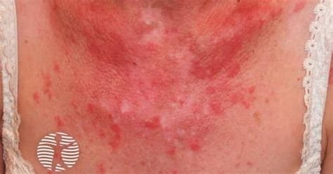 Cutaneous lupus erythematosus image