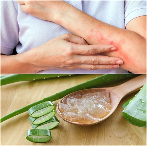 Home Remedies for Mosquito Bites to Stop Itching Fast